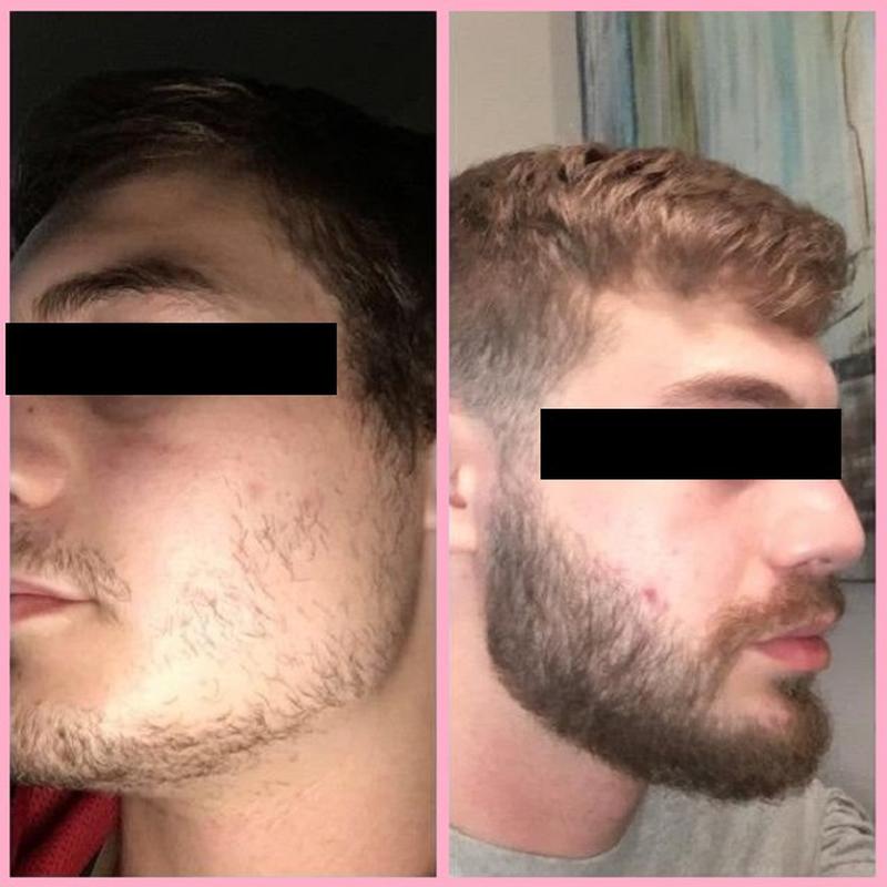 Рост волос на лице у мужчин. Миноксидил для бороды. Препарат для роста бороды миноксидил. Миноксидил 5 процентный для бороды. Миноксидил для волос для мужчин для бороды 5%.